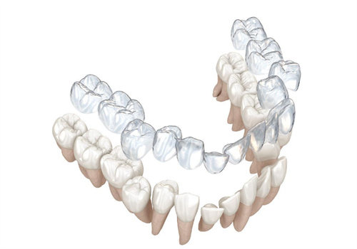 隐形矫正牙齿过程