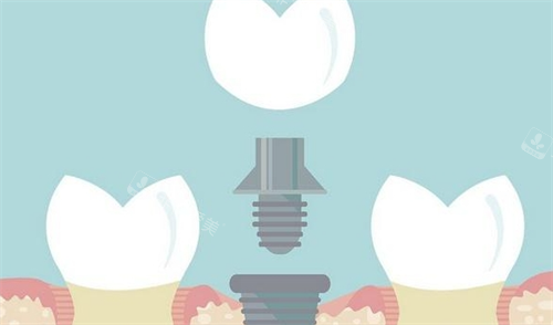 组成种植牙的三部分动画展示