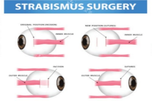 斜视手术前后对比