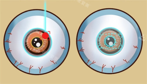 近视手术不同种类的眼球表现