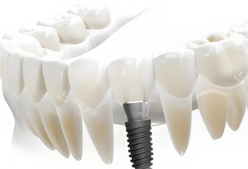 种植牙卡通展示展示图