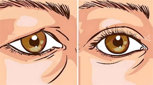 提眉前后变化有哪些