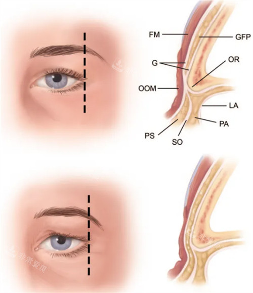 提眉手术层次高清解析
