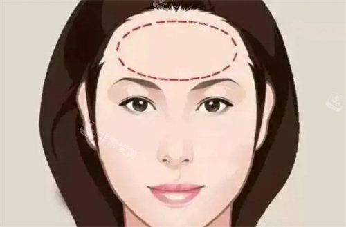 額頭提升 額頭提升