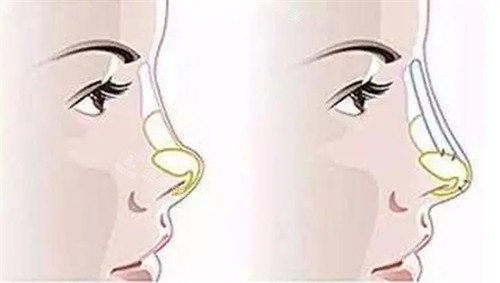 朝天鼻填充假体 朝天鼻填充假体