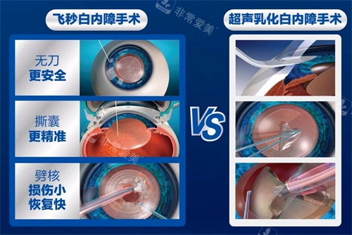 飞秒白内障手术过程