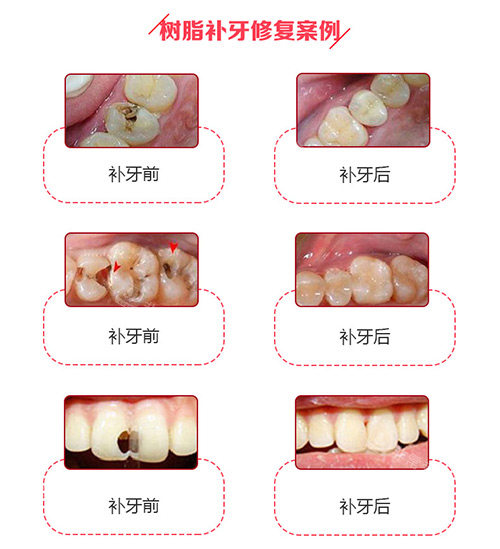 树脂补牙修复实例