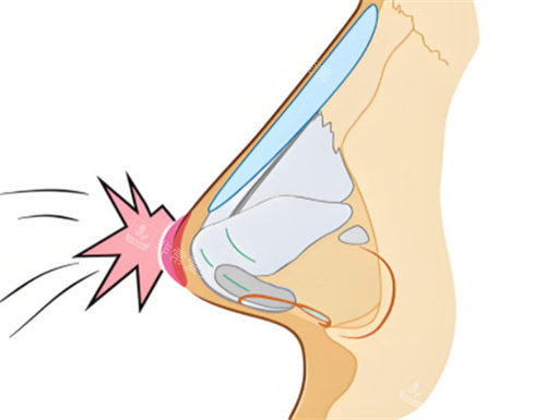 隆鼻修复碰撞成因 隆鼻修复碰撞成因
