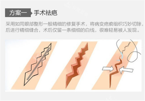 手术祛疤原理图 手术祛疤原理图