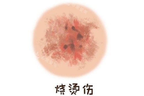 皮肤烫伤疤卡通图 皮肤烫伤疤卡通图