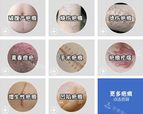 哪些疤痕需要祛除改善 哪些疤痕需要祛除改善