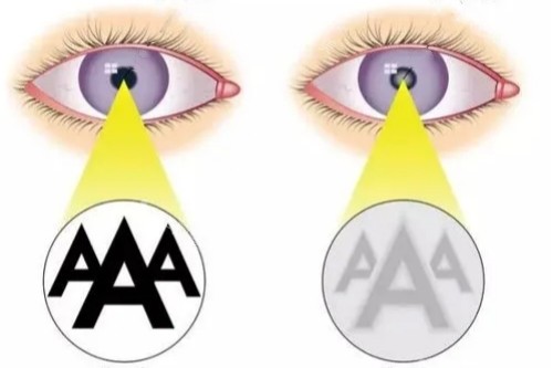 白内障与正常眼睛视物卡通对比图