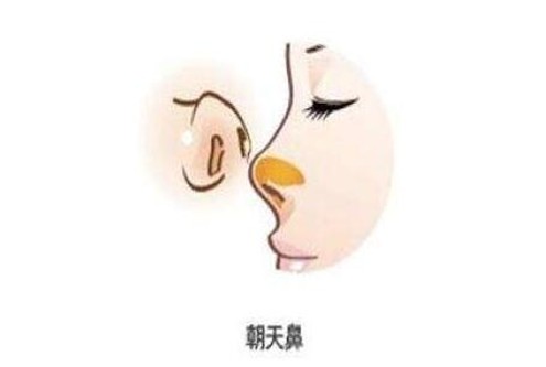朝天鼻整形手术 朝天鼻整形手术
