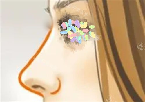 还在纠结韩国做埋线鼻靠谱吗？我选MINT®Lift秘特线，0.3mm螺旋线避透光，术后7天可化妆！