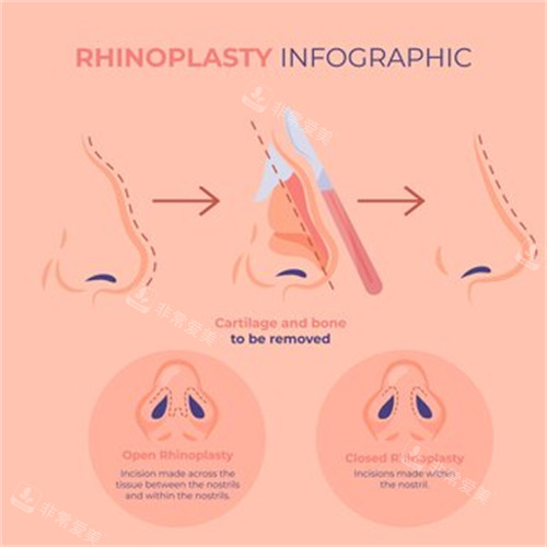 鼻整形过程 鼻整形过程