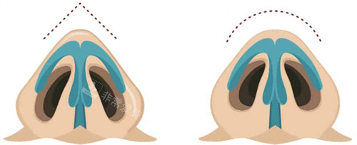 鼻整形动画图 鼻整形动画图