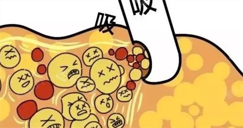 吸脂过程动画展示图 吸脂过程动画展示图