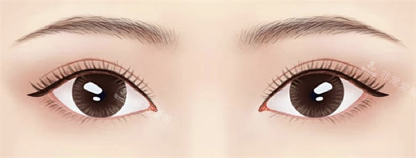 上眼睑松弛矫正