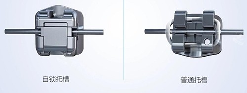 牙齿矫正自锁托槽示意图