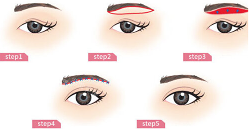 眉弓骨整形手术