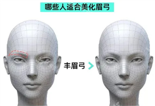 哪些人适合做眉弓整形