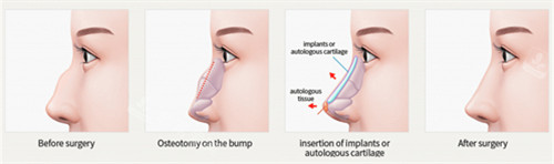 驼峰鼻矫正流程