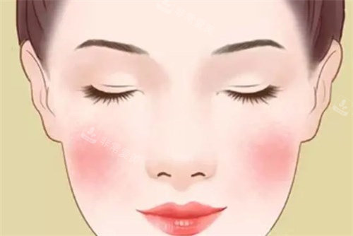 激光去红血丝卡通 激光去红血丝卡通