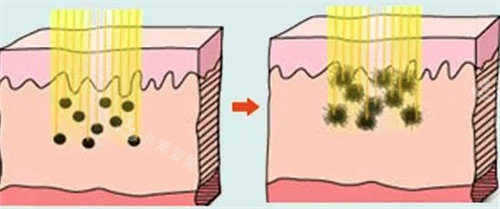 激光去黑色素 激光去黑色素