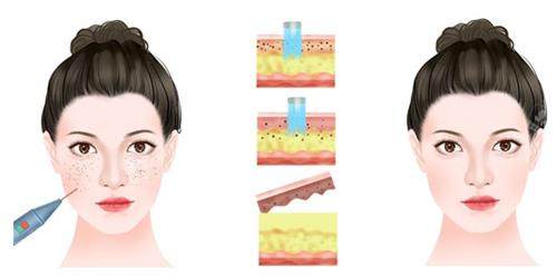 激光祛雀斑示意图 激光祛雀斑示意图