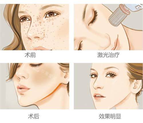 韩国打皮秒体验感咋样？全程温和不刺痛，搭配惊艳前后对比，变漂亮超轻松！