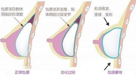 假体隆胸包膜挛缩 假体隆胸包膜挛缩