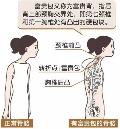 正常骨骼跟有富贵包的骨骼 正常骨骼跟有富贵包的骨骼