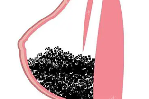 假体隆胸五个月躺下硬邦邦？别慌！用我的亲身经历帮你解答疑惑！