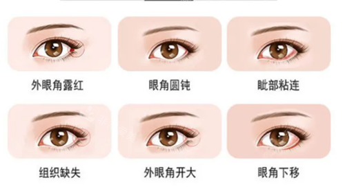 北京客莱美舍整形眼角手术