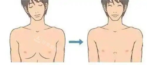 男性乳房发育吸脂后示意图
