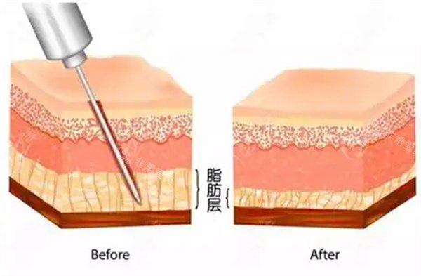 吸脂手术操作 吸脂手术操作