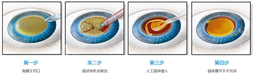 超声乳化白内障手术流程图