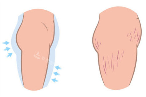 瘦身后大腿留下的肥胖纹 瘦身后大腿留下的肥胖纹