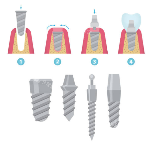 种植牙详解图