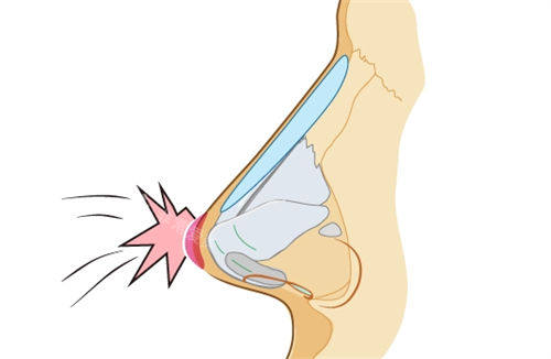 隆鼻假体鼻背动画展示图 隆鼻假体鼻背动画展示图
