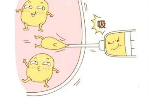 吸脂卡通展示图 吸脂卡通展示图