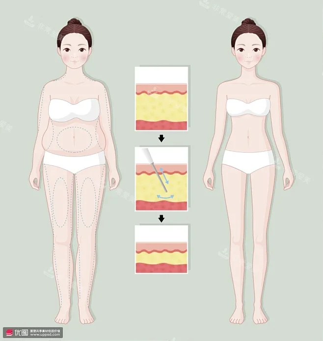 全身吸脂手术 全身吸脂手术