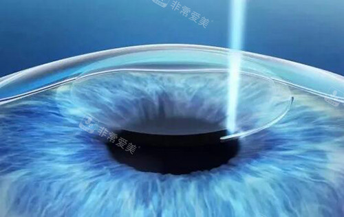 飞秒激光展示图