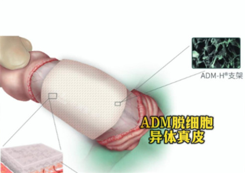 阴茎生物补片ADM材料是什么 阴茎生物补片ADM材料是什么