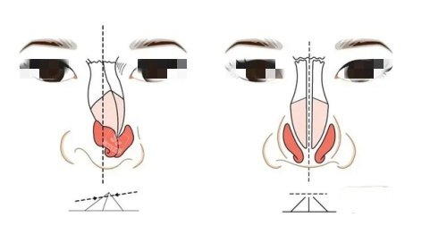 假体鼻子歪斜漫画示意图