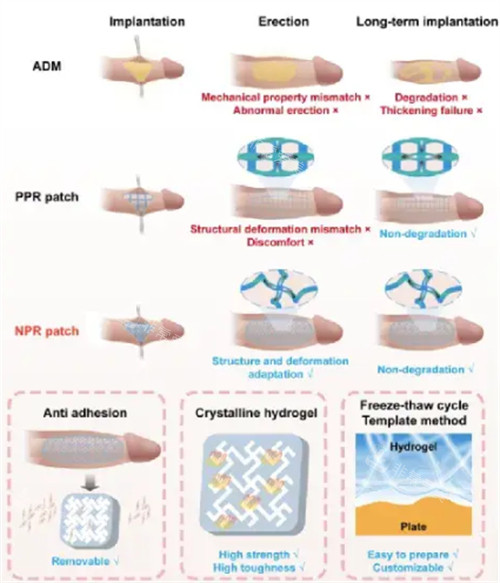 阴茎生物补片手术过程