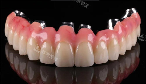 马龙桥种植牙技术