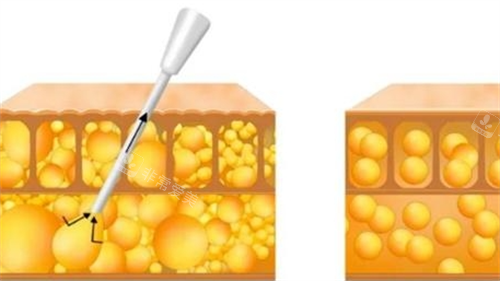 吸脂过程动画脂肪前后变化