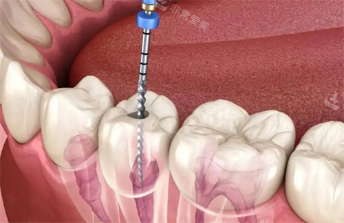 根管治疗动画透视图