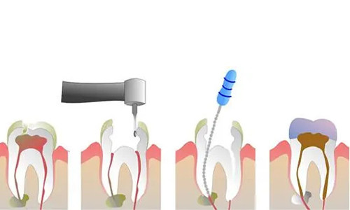 根管治疗过程的示意图